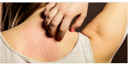 Stress rash, yes stress can cause hives!